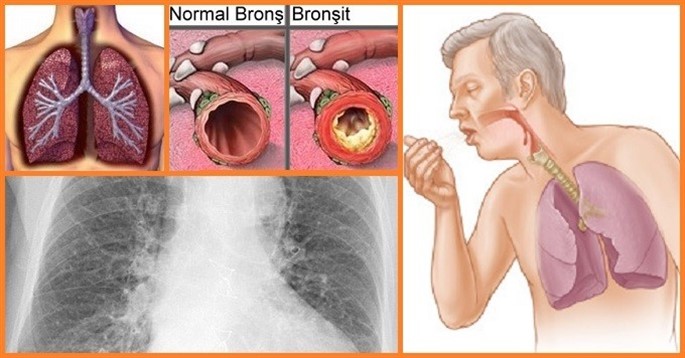 bronşit 3