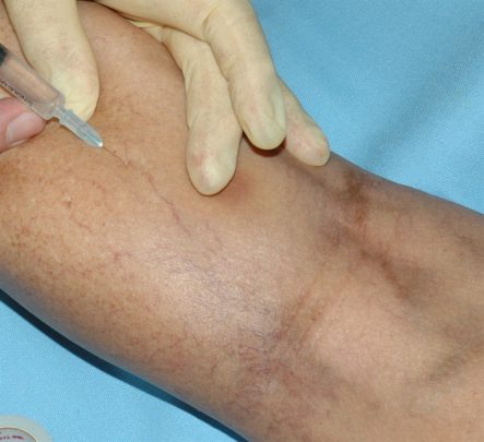 skleroterapi 3