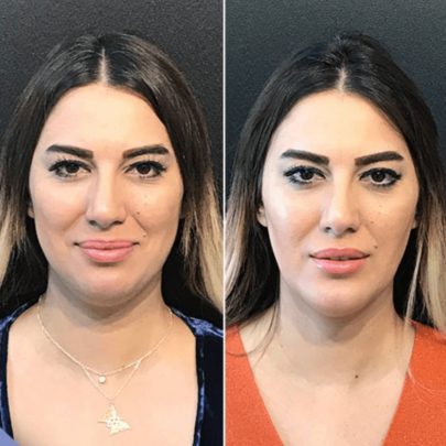 Bişektomi