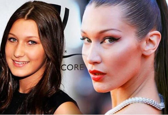 Bişektomi (Hollywood Yanağı) Nedir? 3 Bişektomi